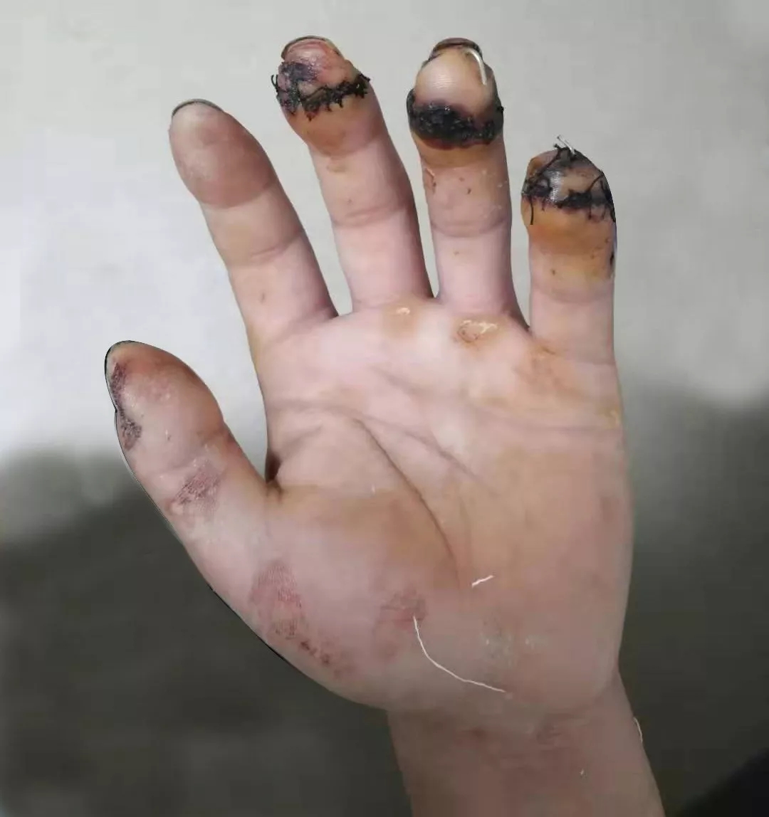 杭州城东医院手足外科,手足外科案例