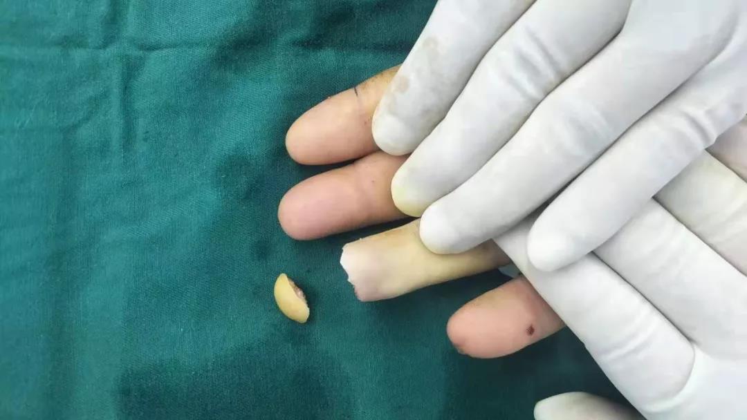 杭州城东医院,手足外科案例,杭州城东医院案例