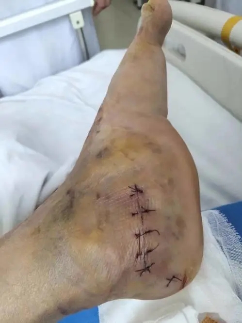 杭州城东医院骨科,杭州骨科医院哪家好